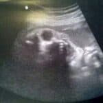 El bebe no nacido de aurora simons
