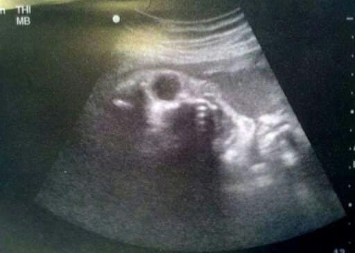 El bebe no nacido de aurora simons