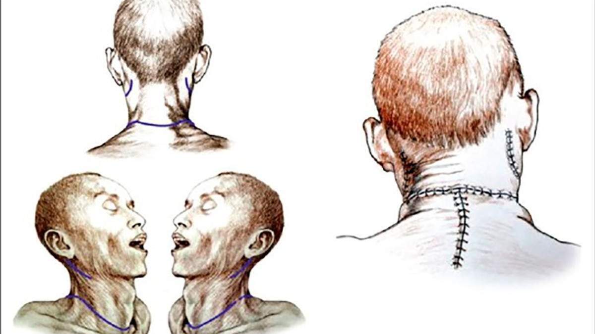 trasplante de cabeza